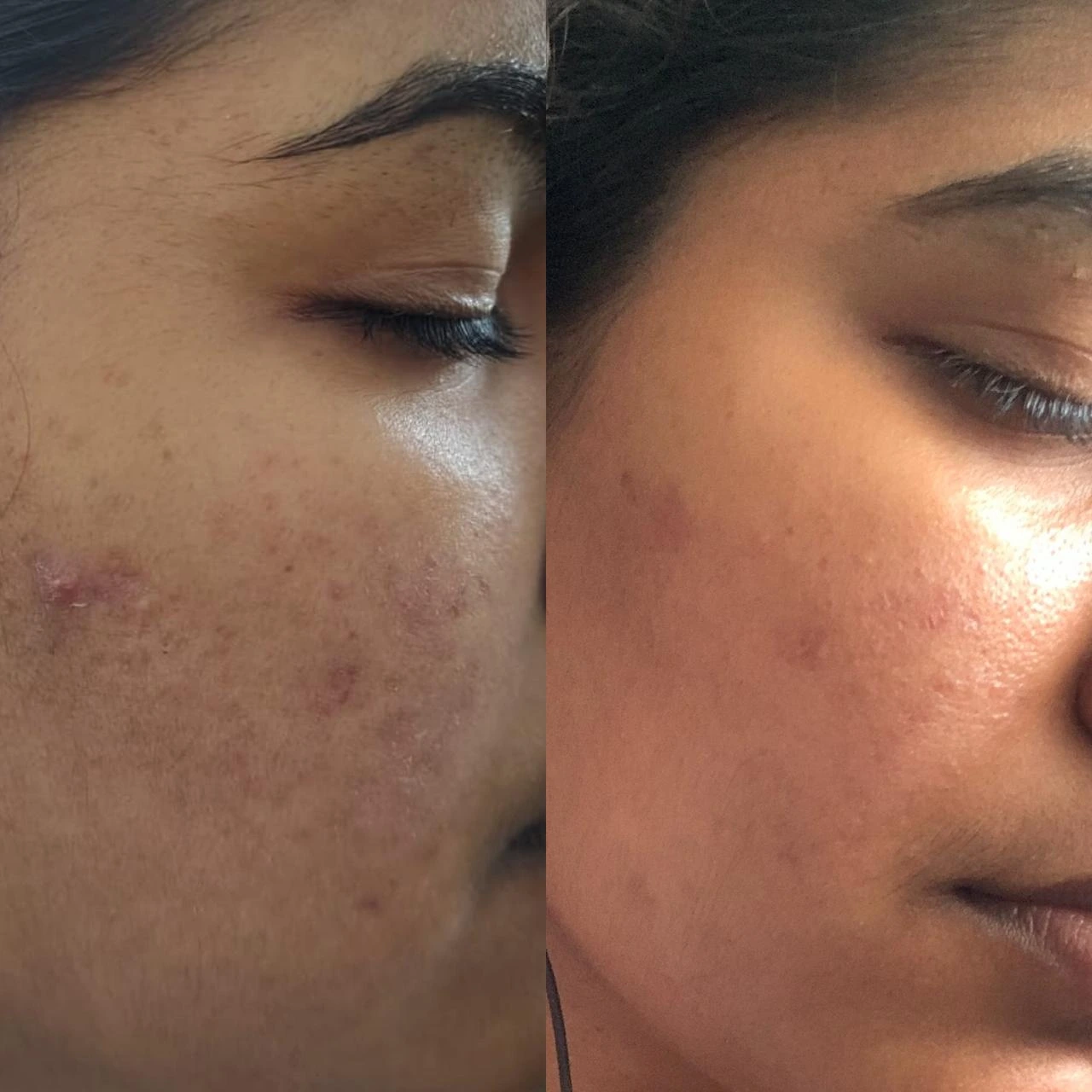 Acne Treatment – after