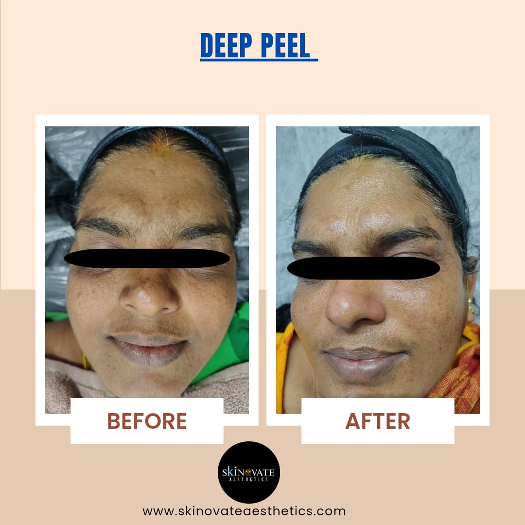 Anti-aging Therapy – after