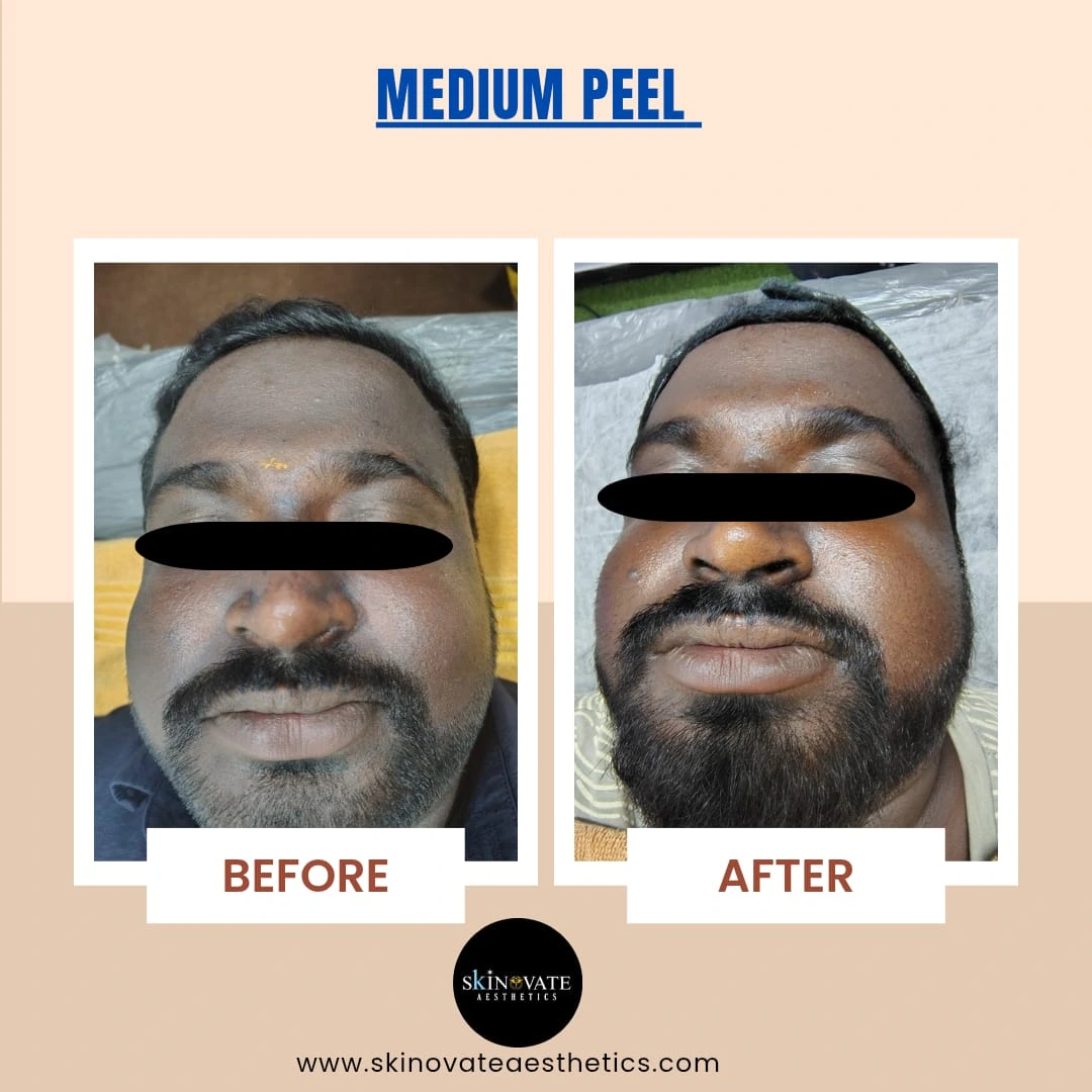 Pigmentation Reduction – after