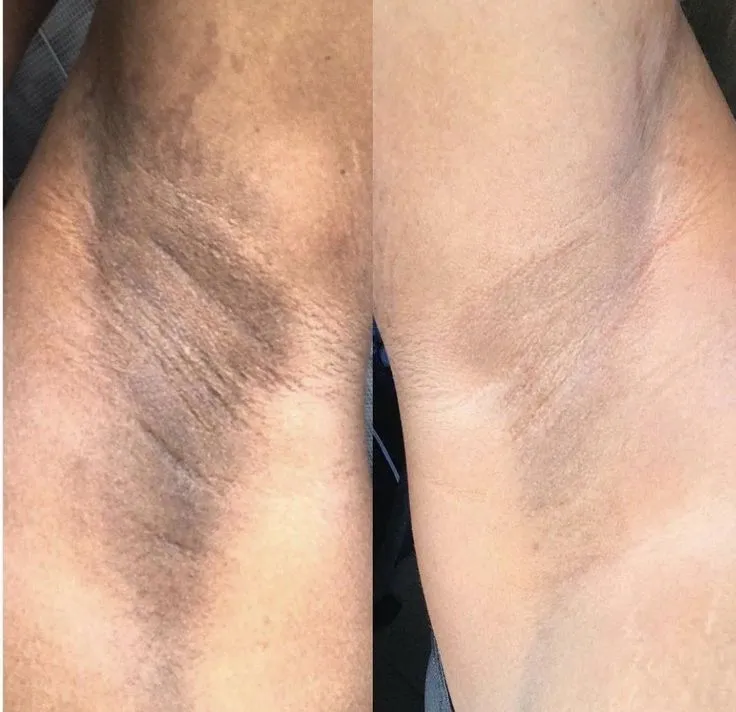 Underarm & Bikini Hair Removal