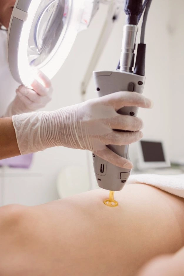 Laser Hair Removal in Coimbatore