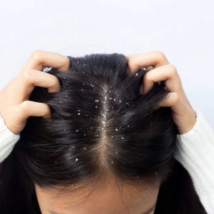 Anti Dandruff Therapy at Skinovate Coimbatore