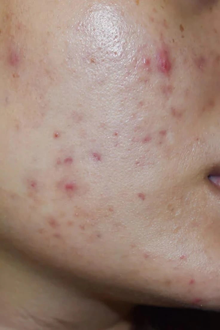 Acne and Pimple Treatment at Skinovate Coimbatore