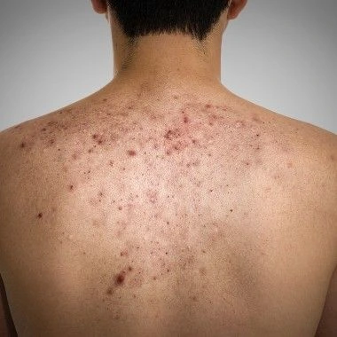 Acne Scars